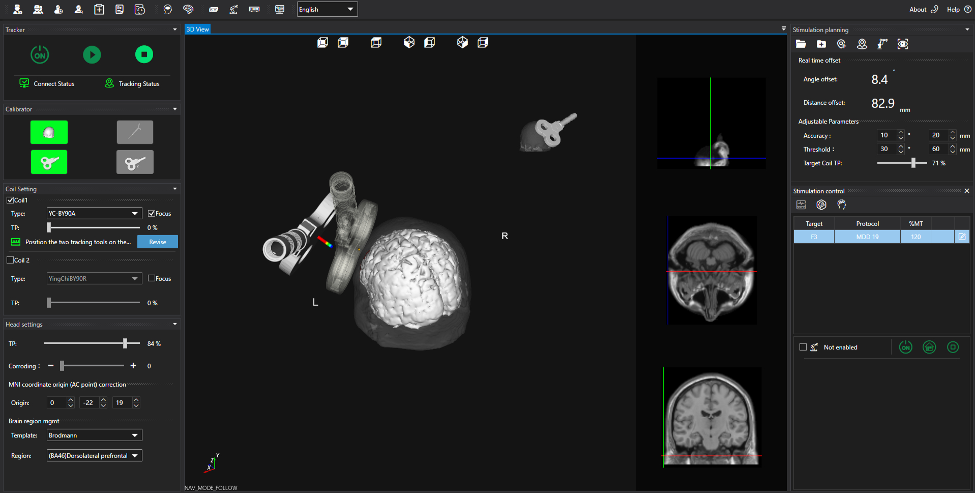 The live guidance display during a session, with the Real time offset panel reading the coil's angle and distance from target beside adjustable accuracy and threshold parameters, as the tracked coil is brought toward the 3D head model.